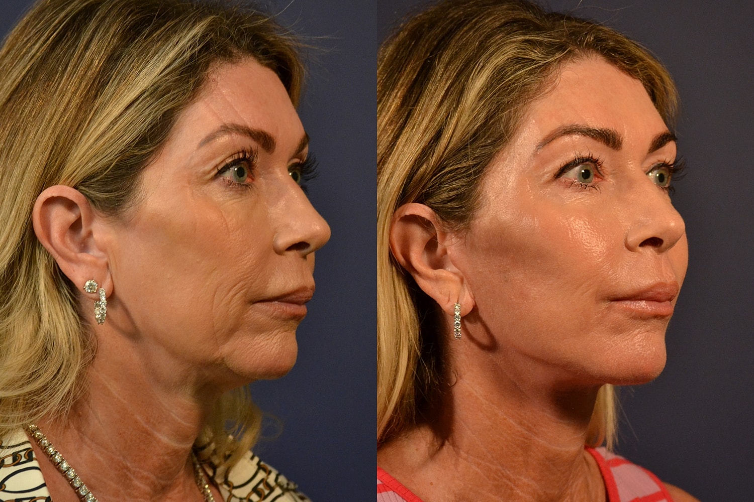 Before and after cosmetic treatment comparison.