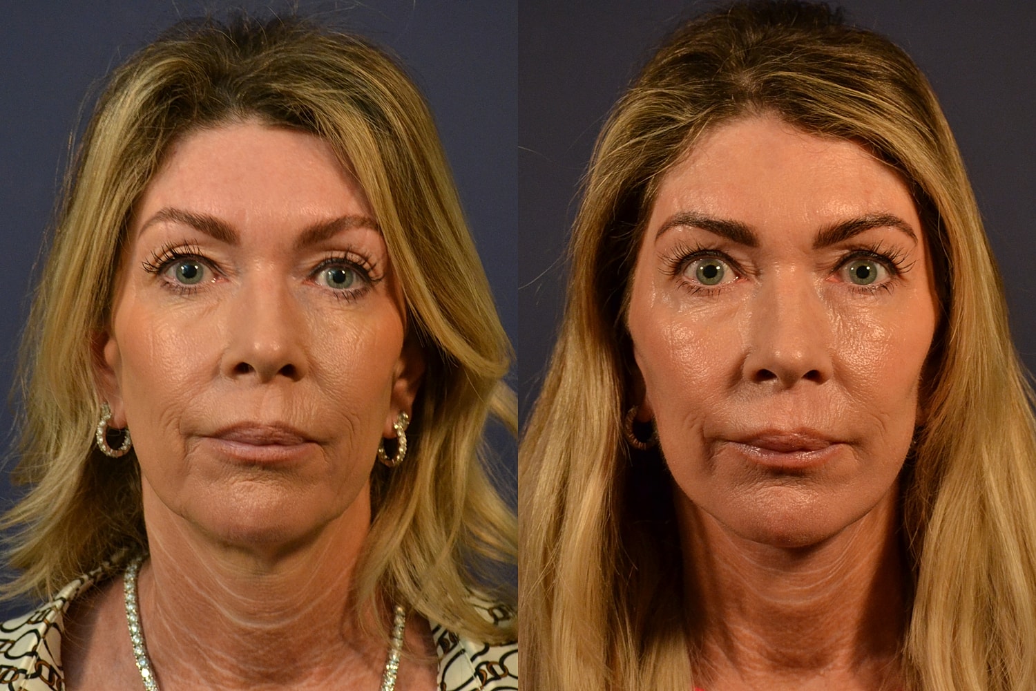 Before and after skincare treatment photos.