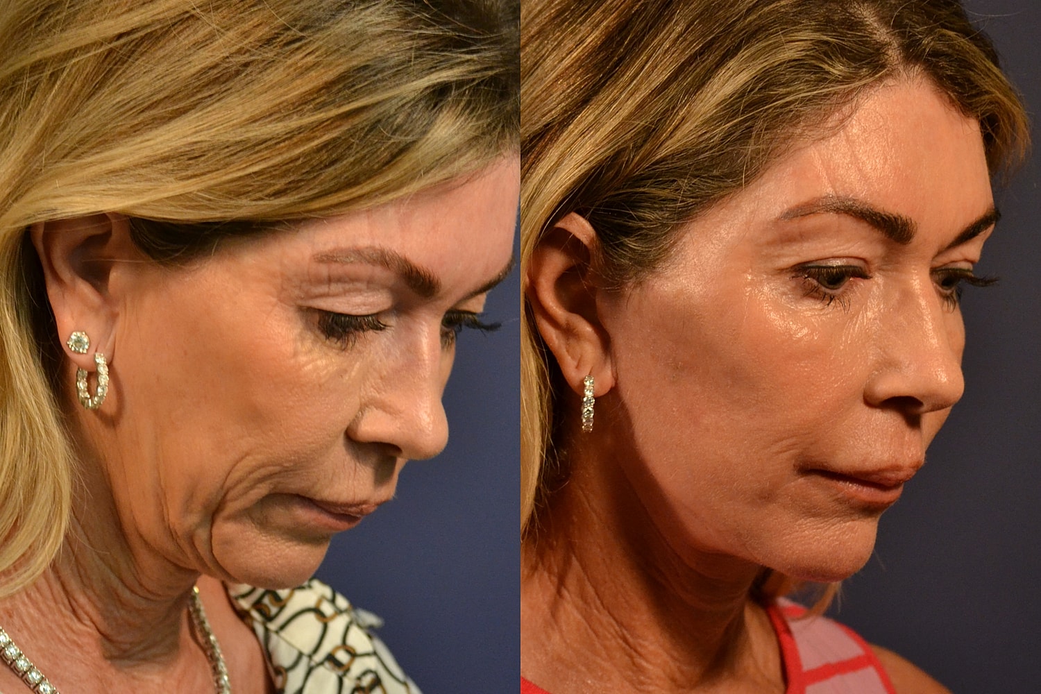 Before and after cosmetic procedure side profile.