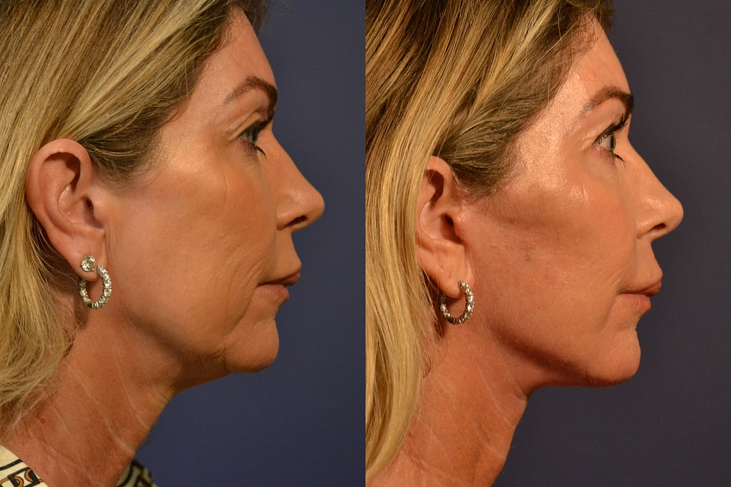 Profile comparison showing facial rejuvenation results.