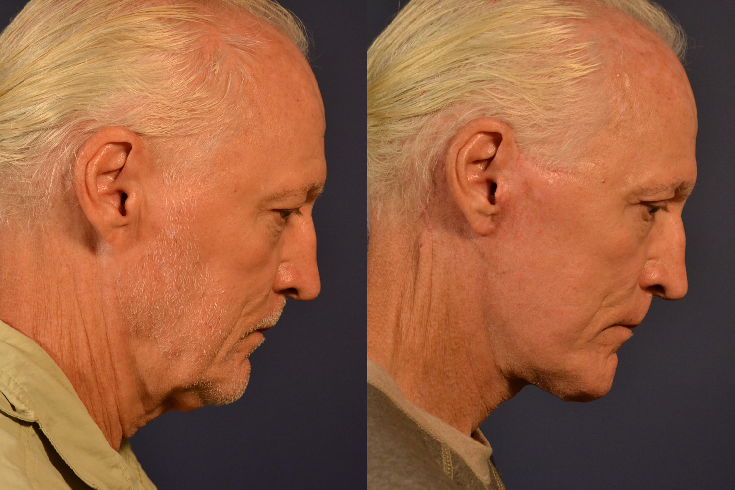 Facelift Before & After