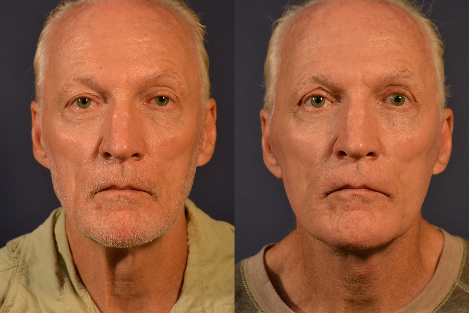 Facelift Before & After
