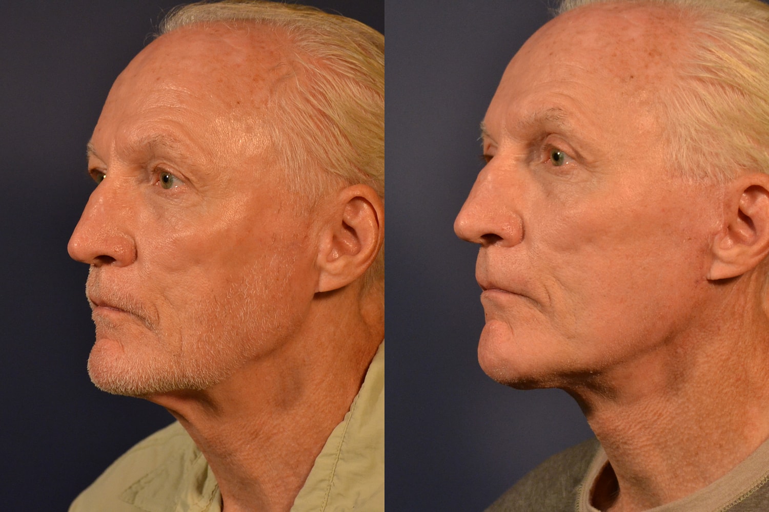 Facelift Before & After