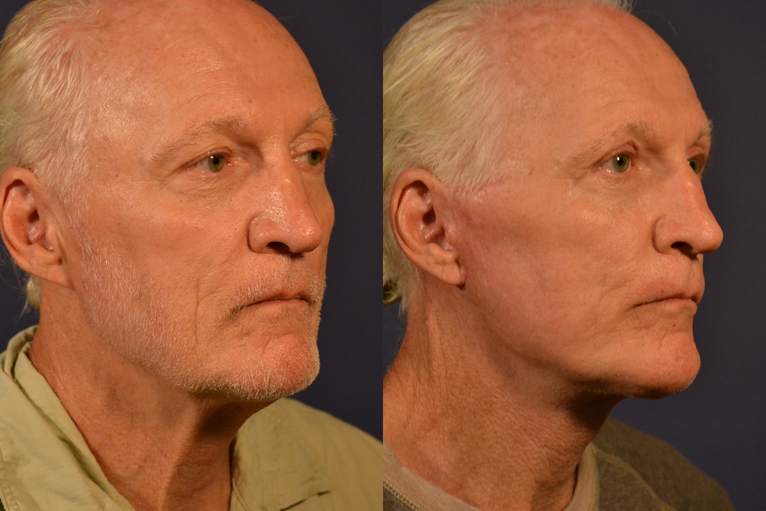 Facelift Before & After