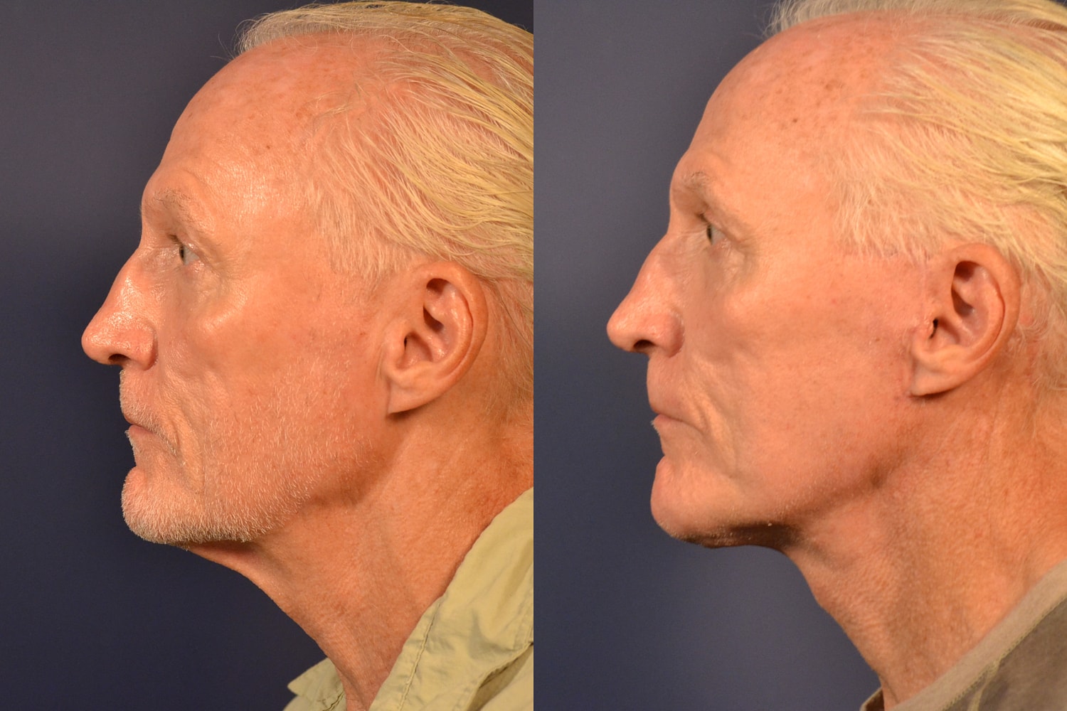 Facelift Before & After