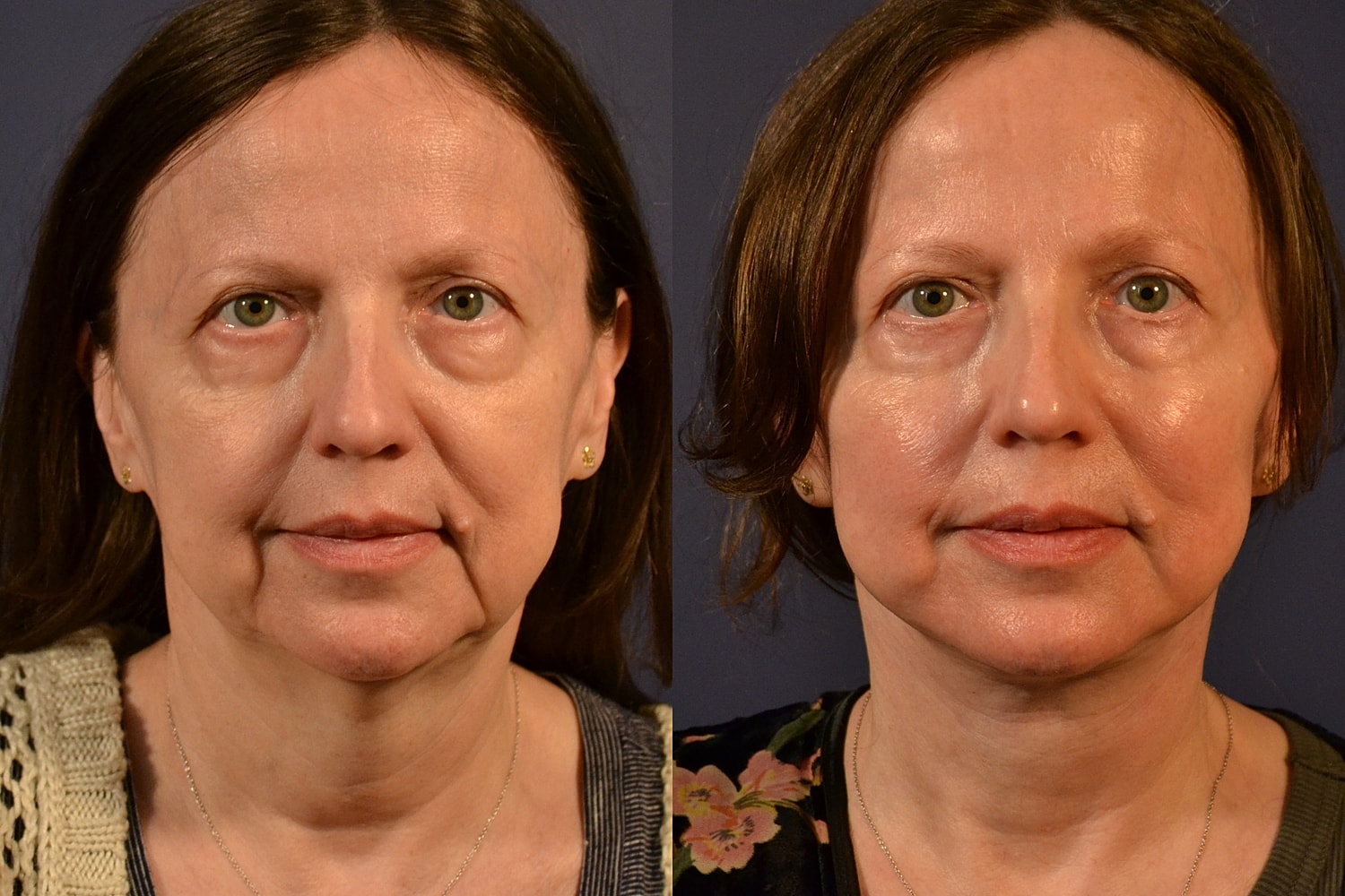 Facelift Before & After