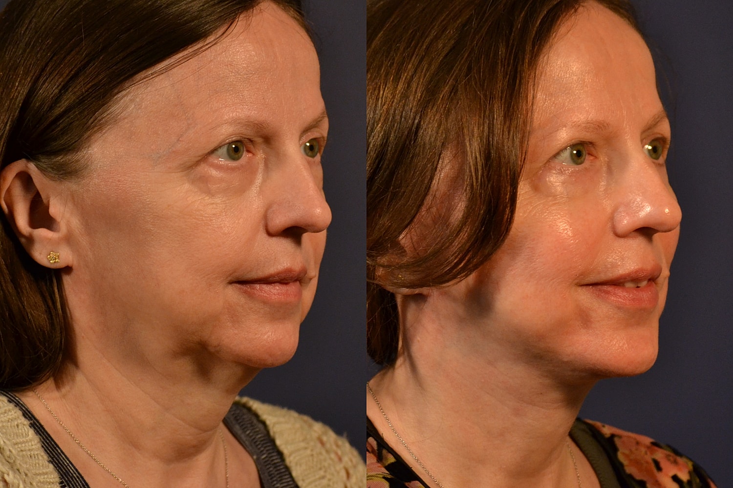 Facelift Before & After