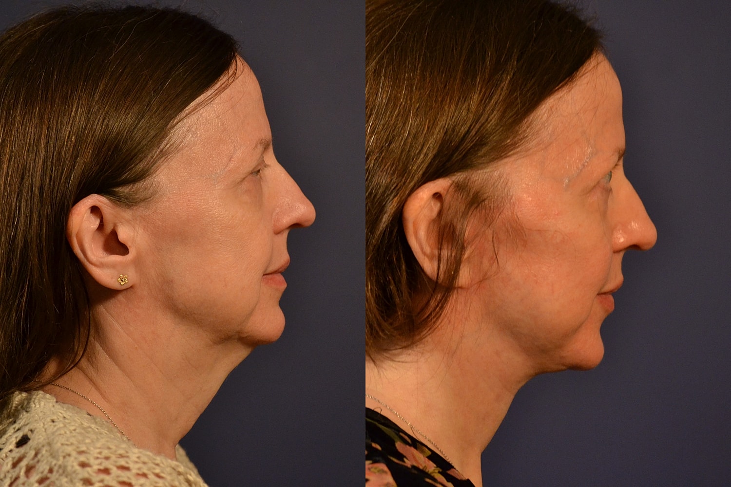 Facelift Before & After