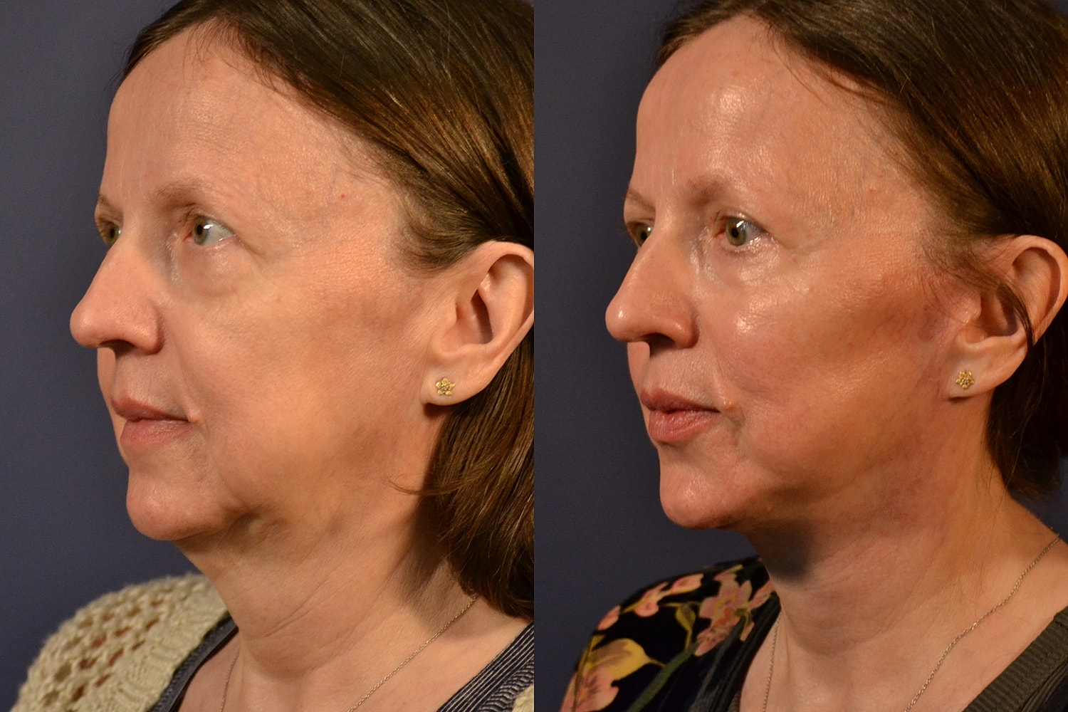 Facelift Before & After