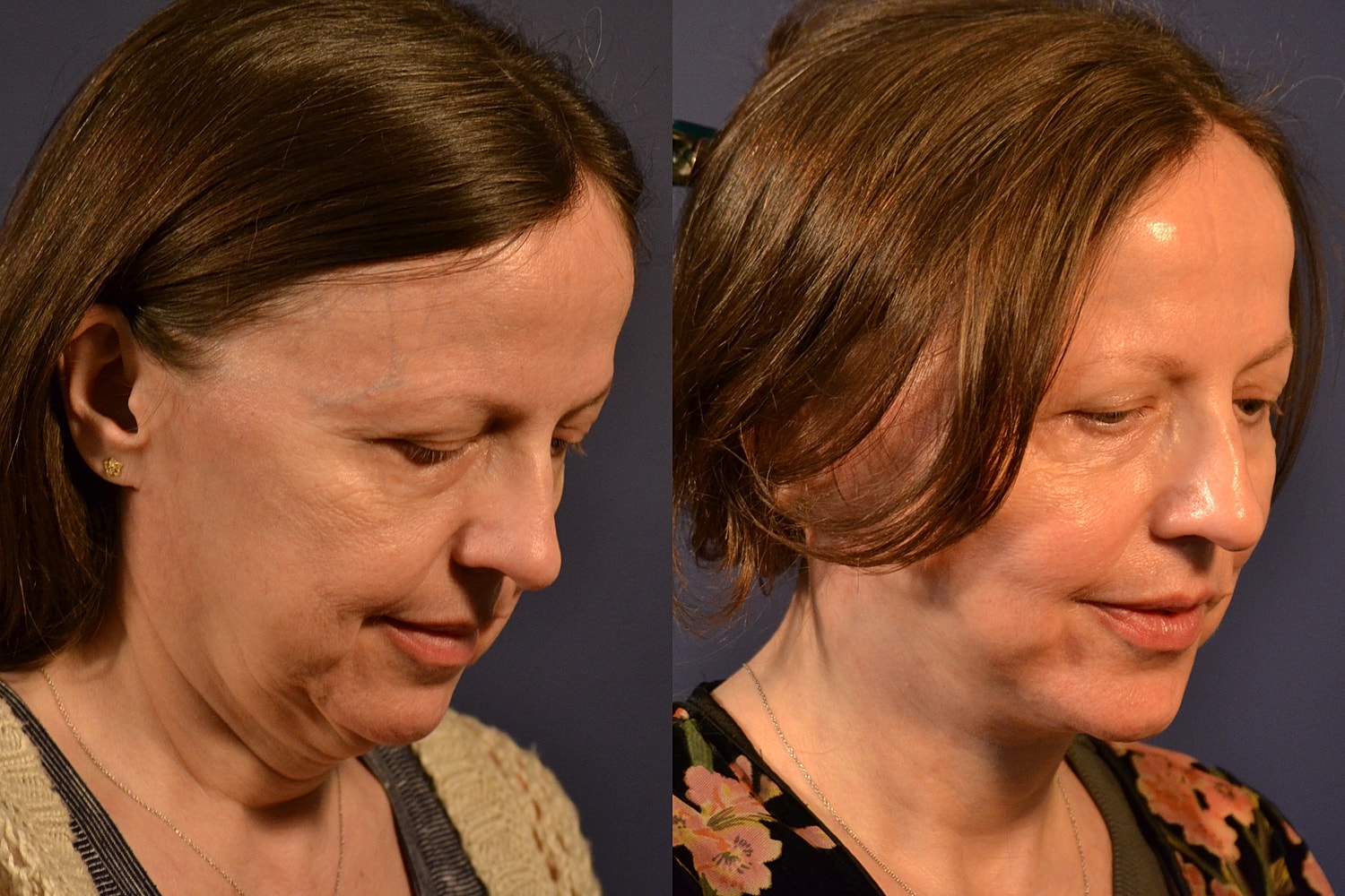 Facelift Before & After