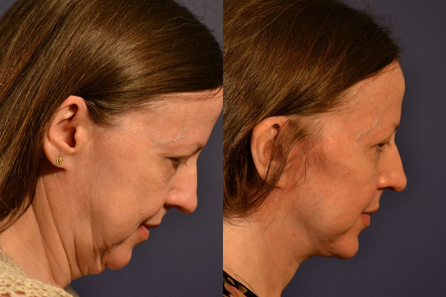 Facelift Before & After