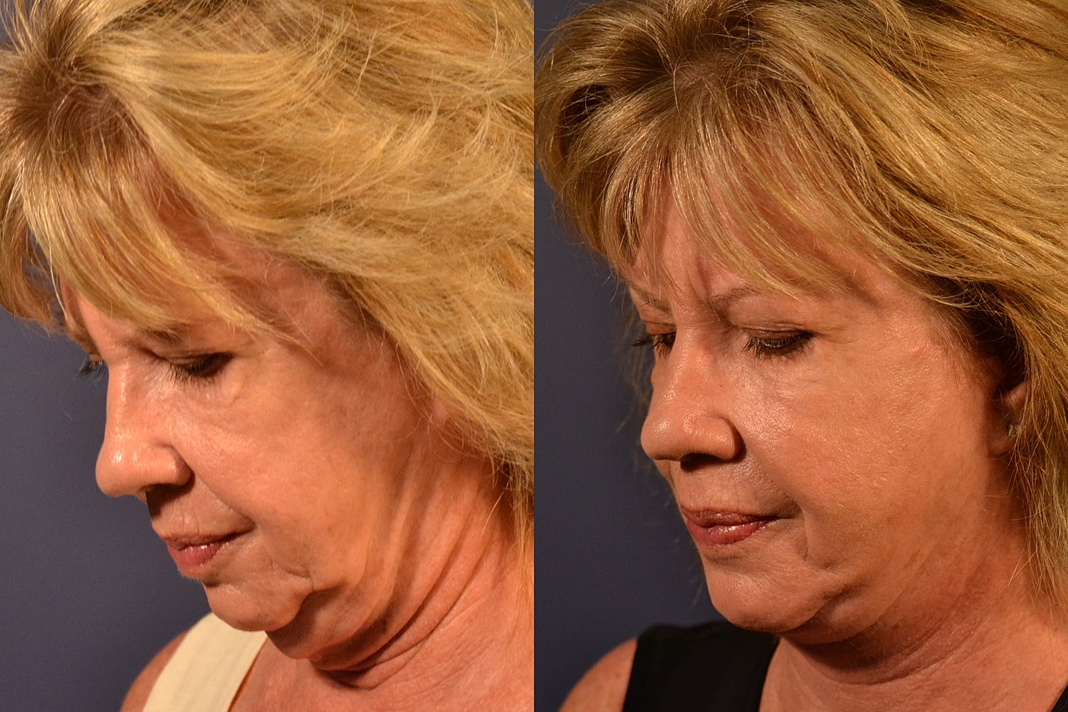 Facelift Before & After