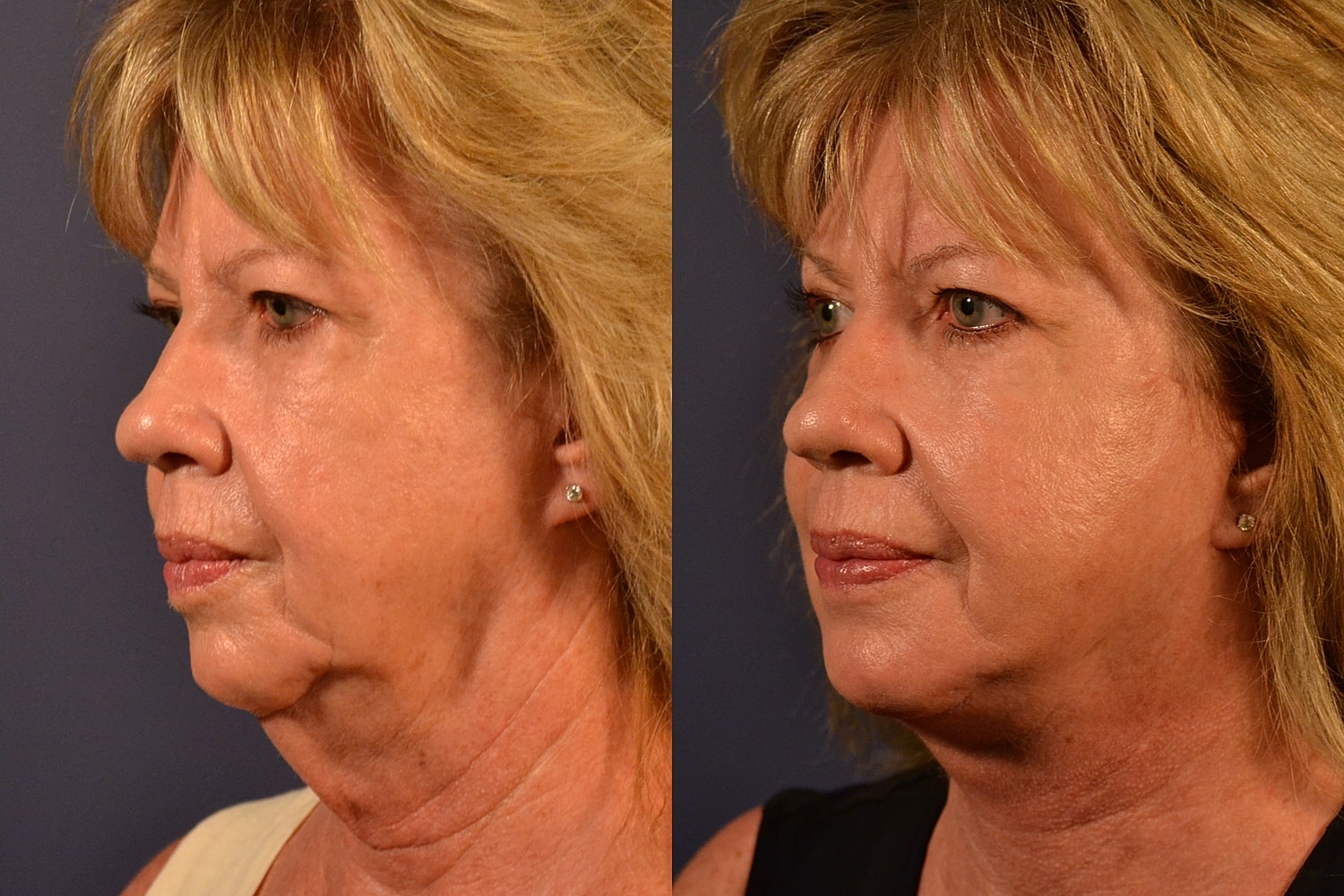 Facelift Before & After