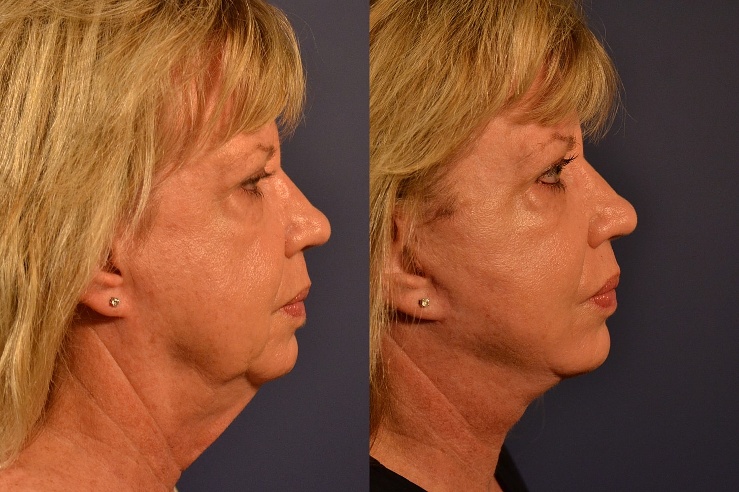 Facelift Before & After
