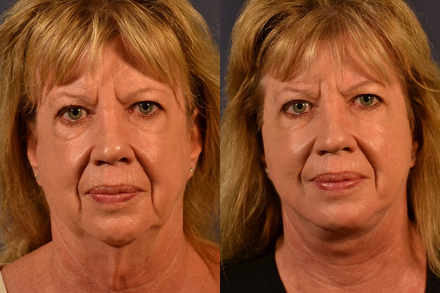 Facelift Before & After