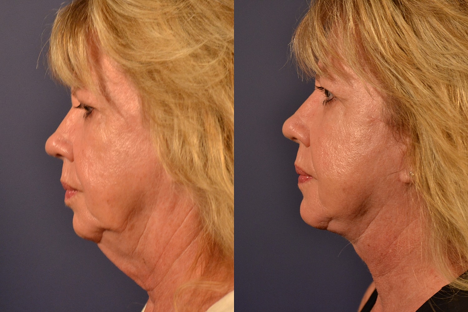 Facelift Before & After
