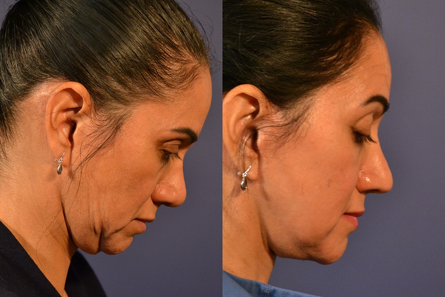 Facelift Before & After
