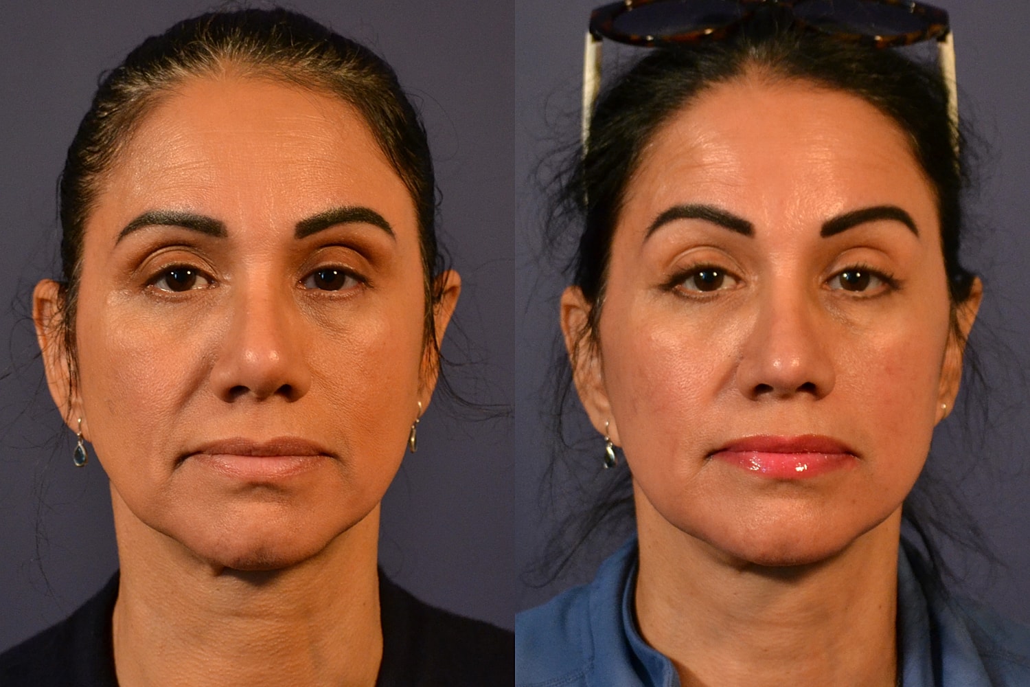 Facelift Before & After