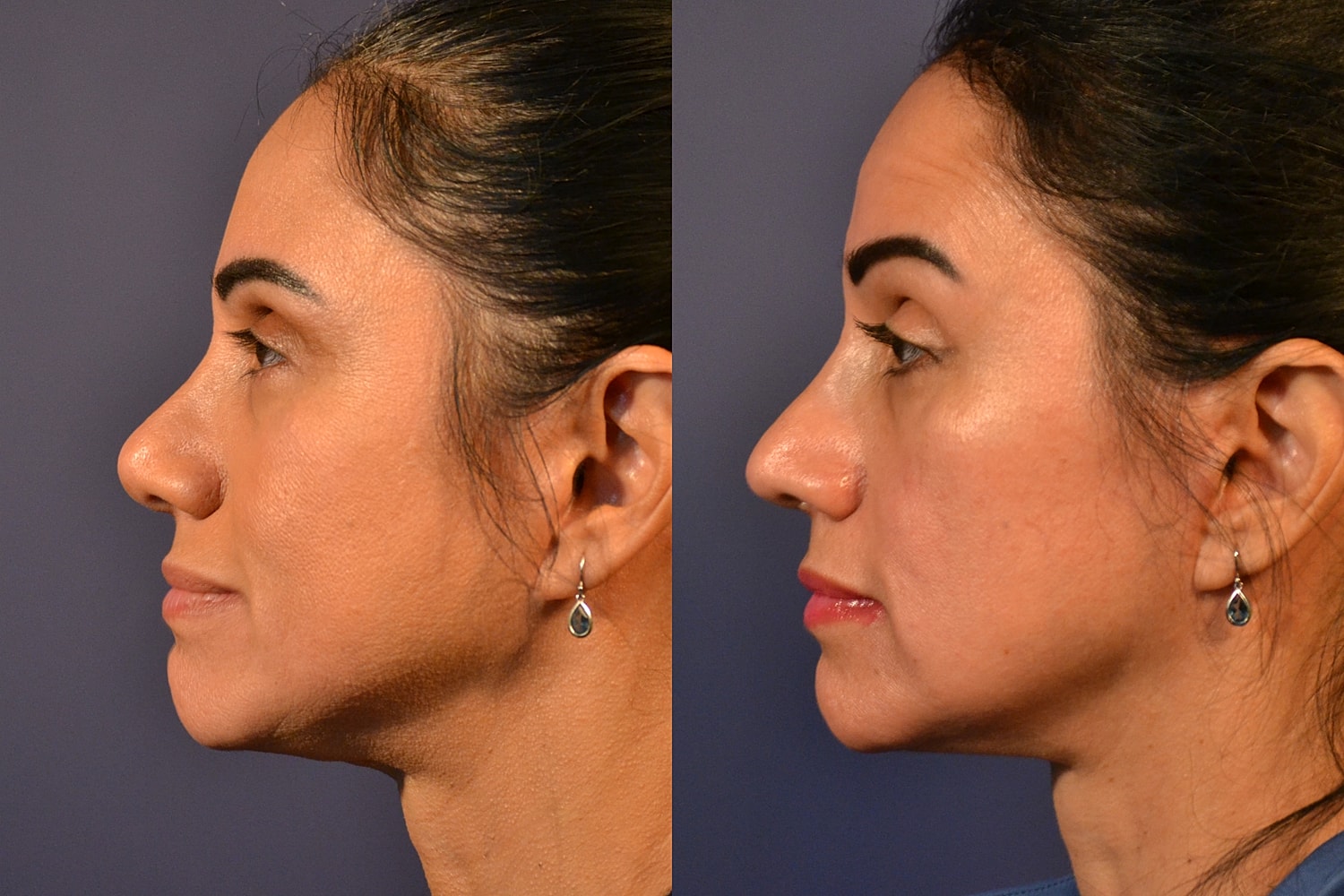 Facelift Before & After
