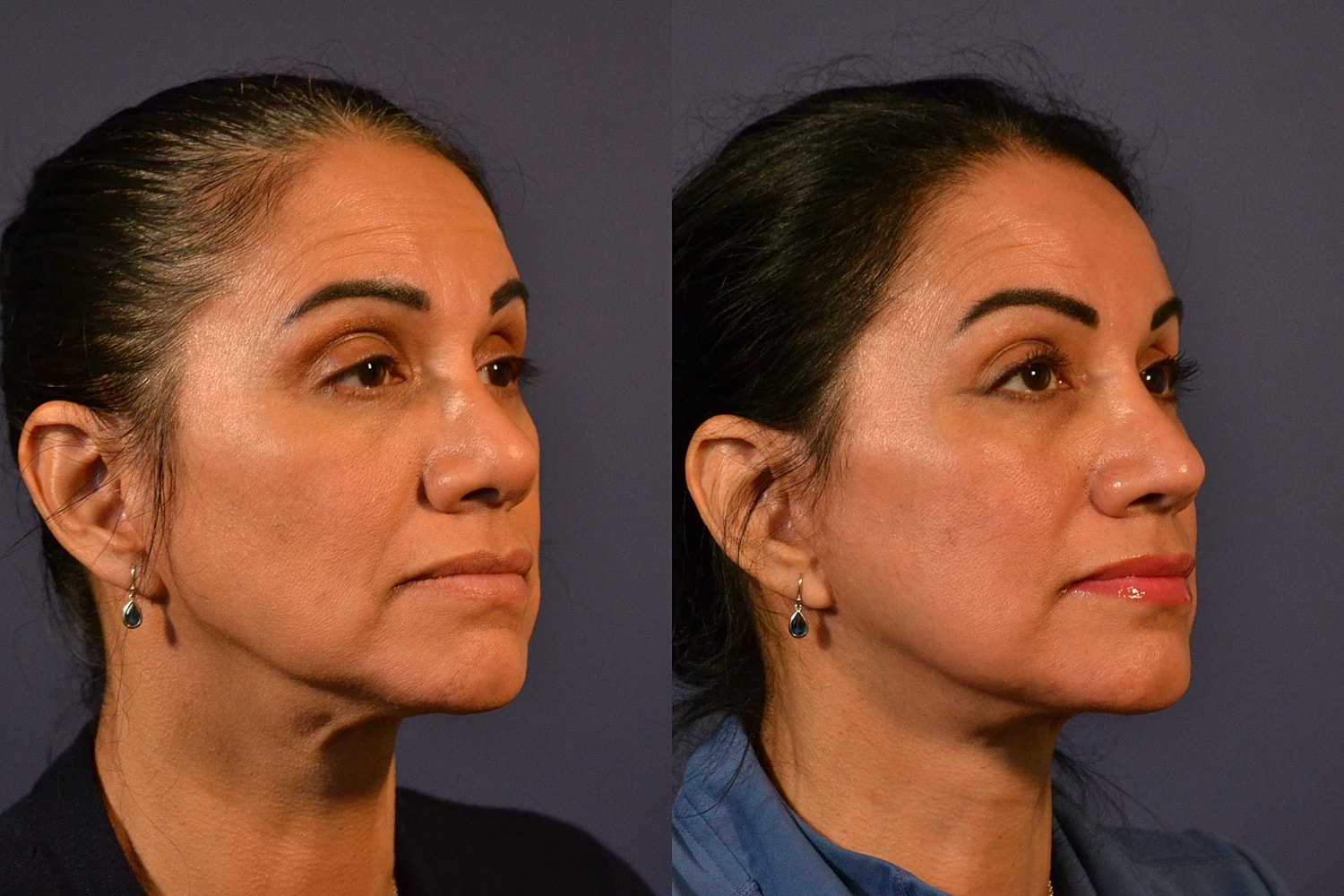 Facelift Before & After