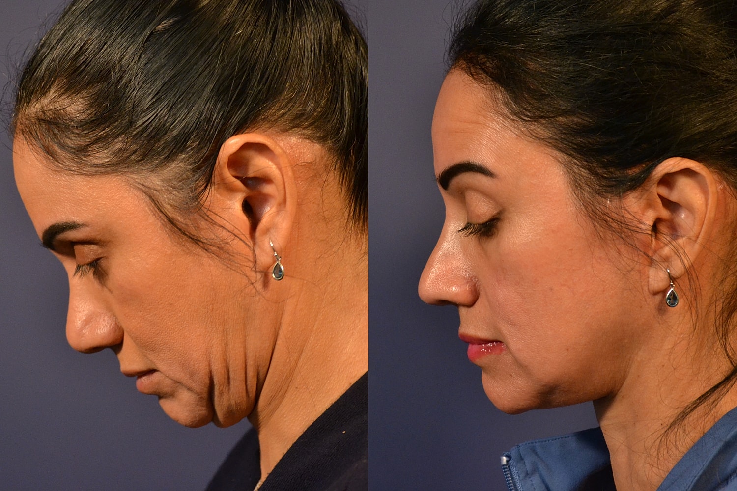 Facelift Before & After