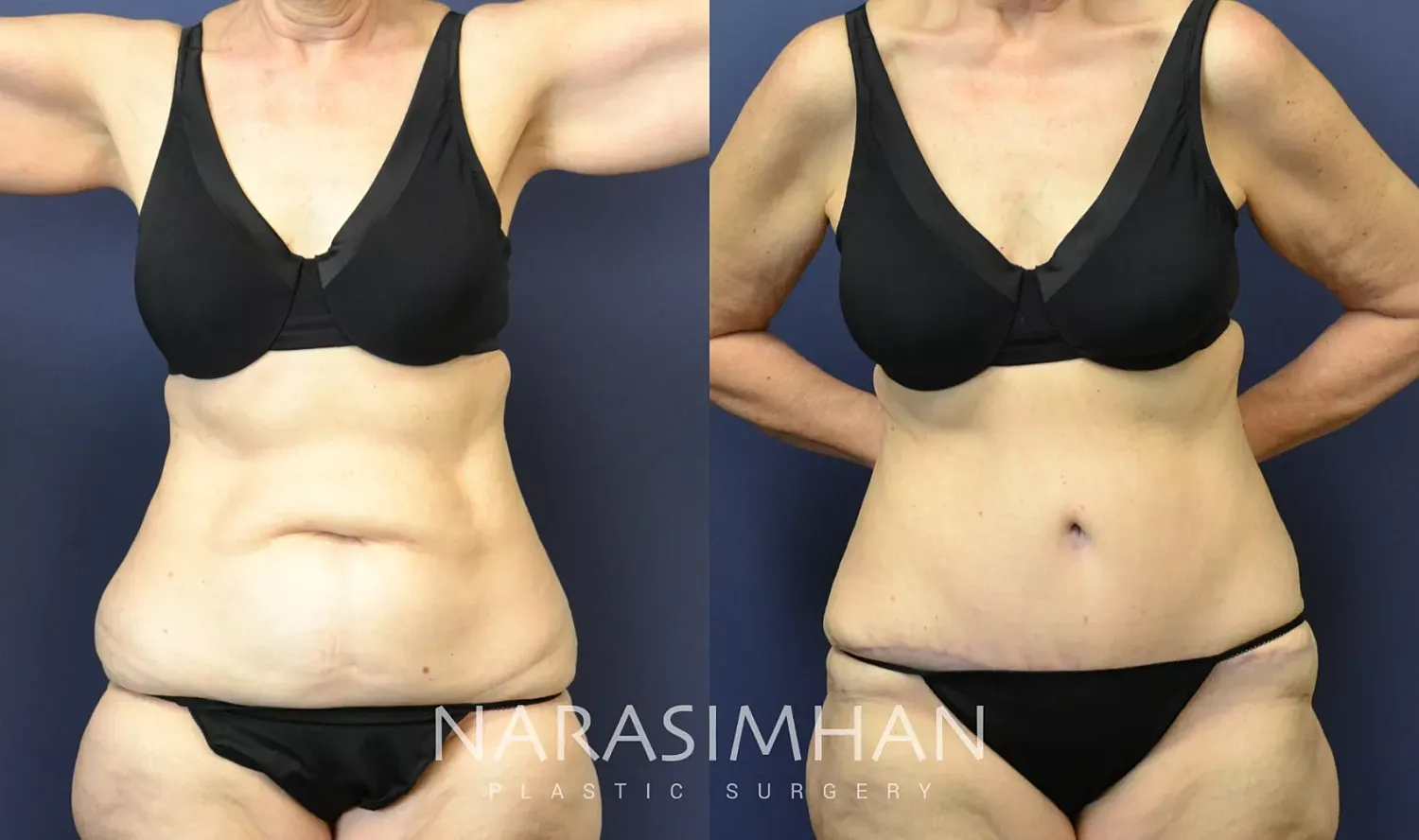Liposuction Before & After