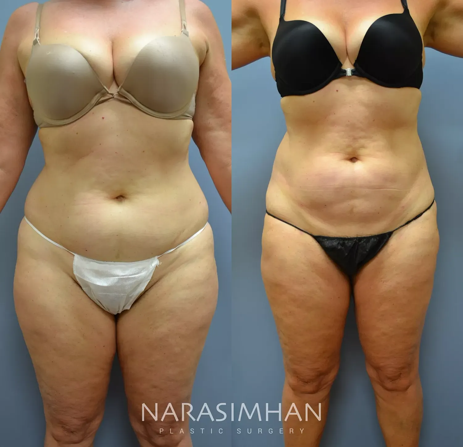 Liposuction Before & After