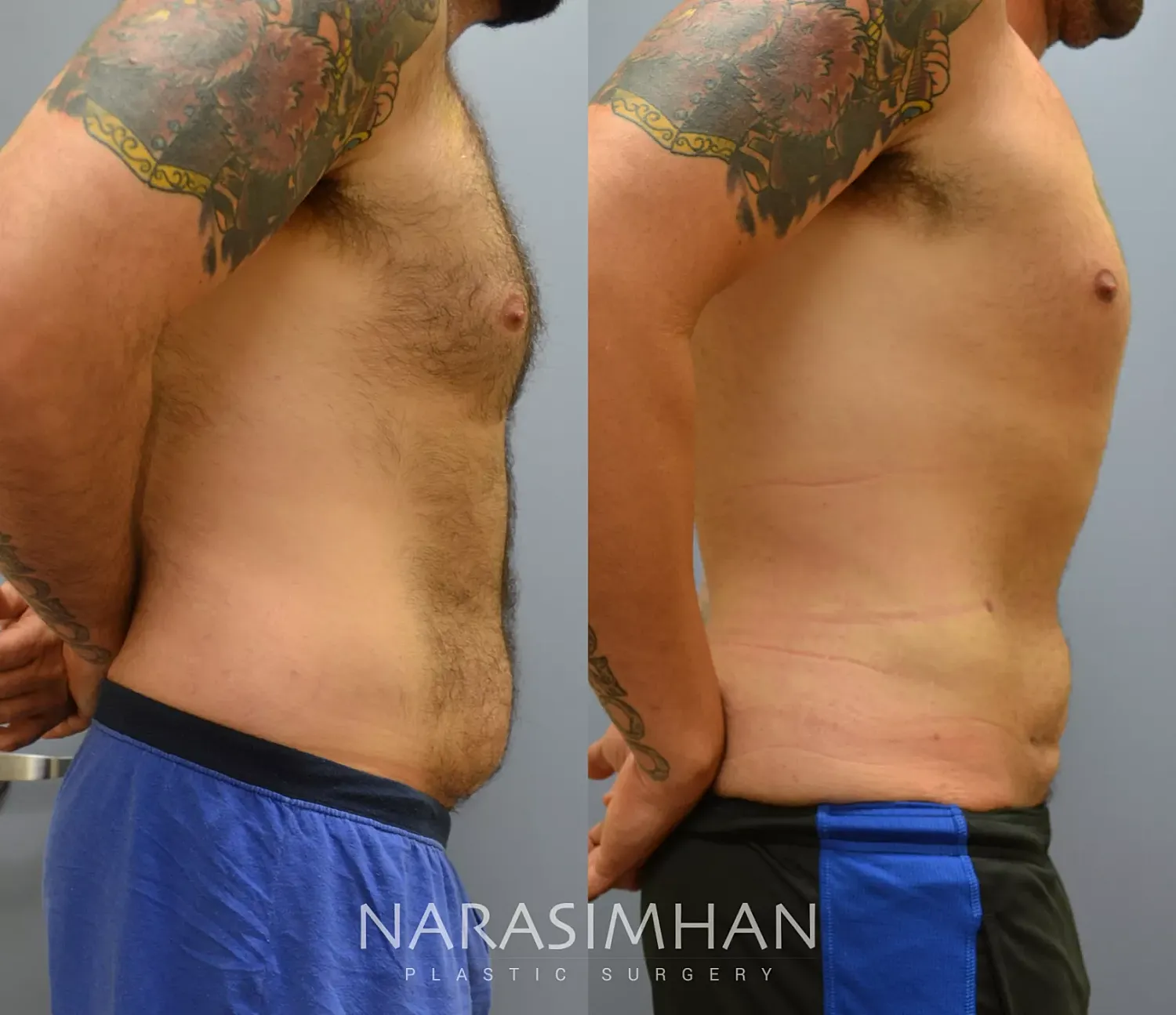 Liposuction Before & After