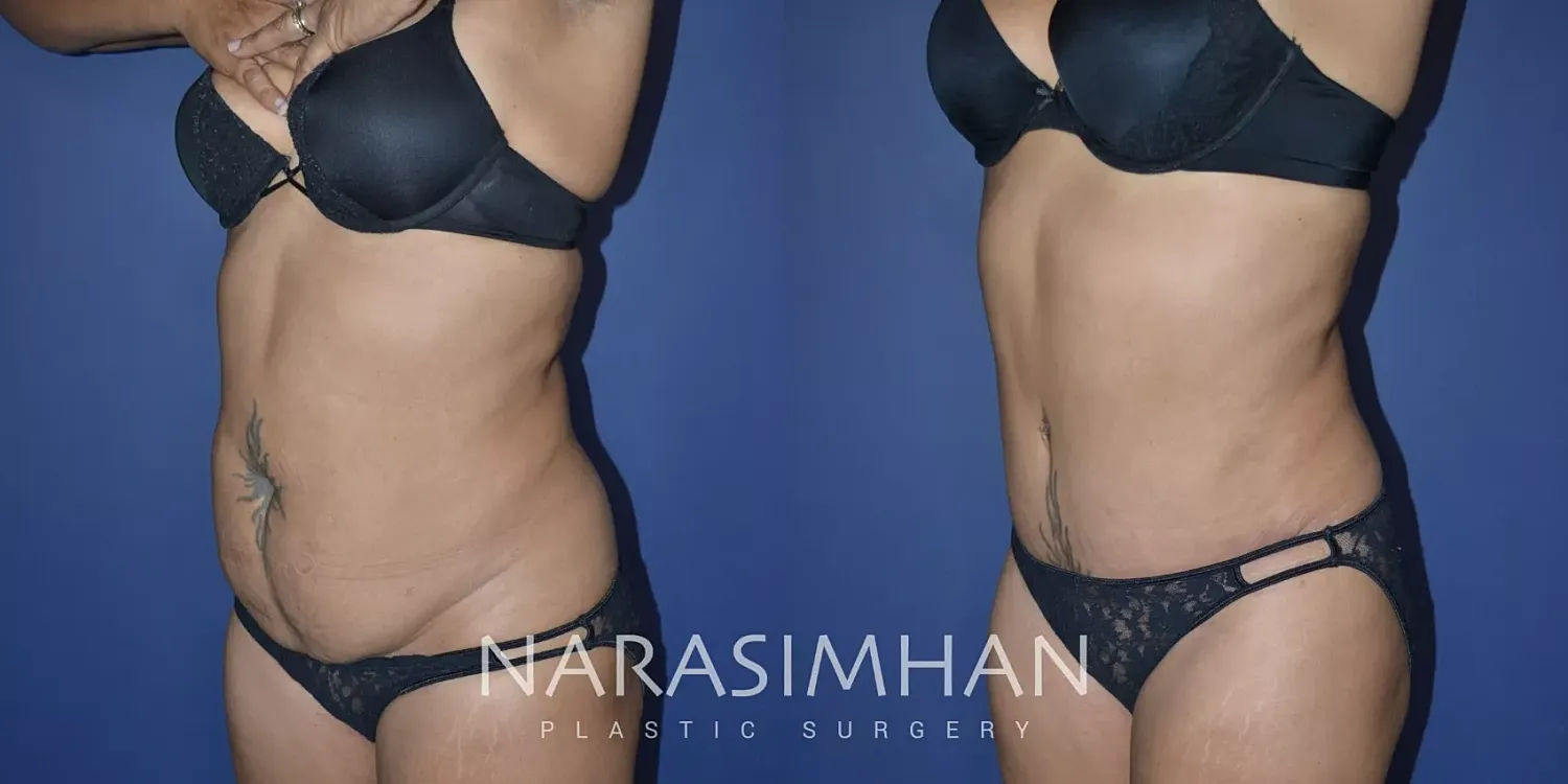 Liposuction Before & After