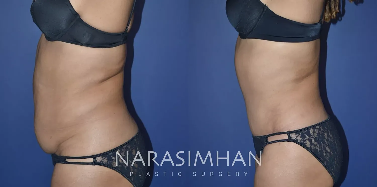 Liposuction Before & After