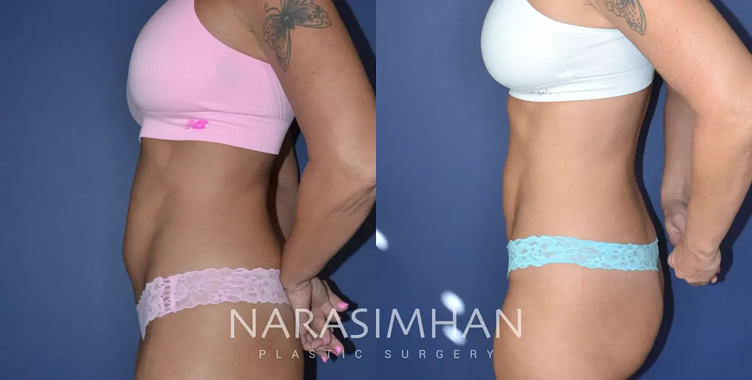 Liposuction Before & After