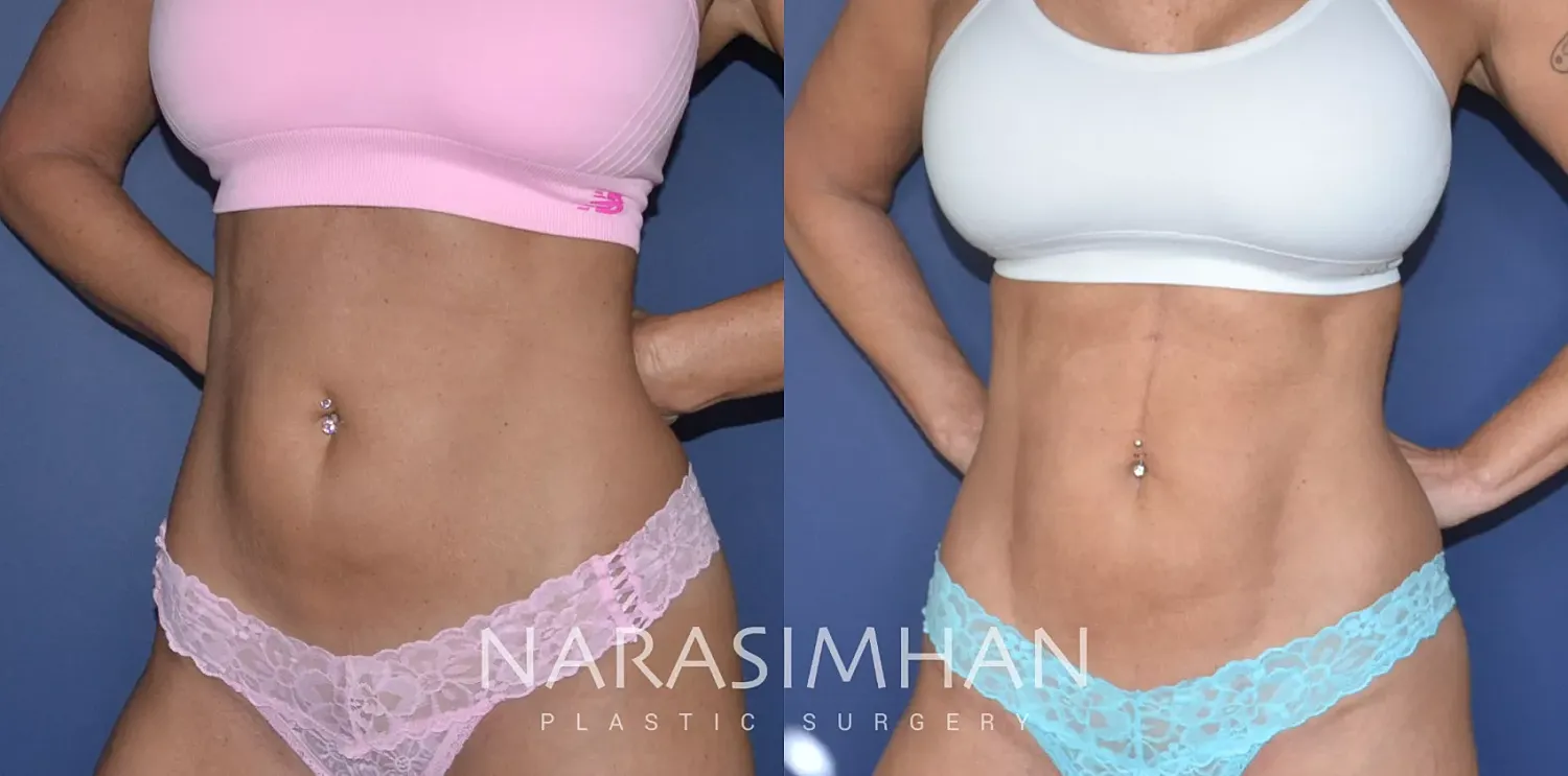 Liposuction Before & After