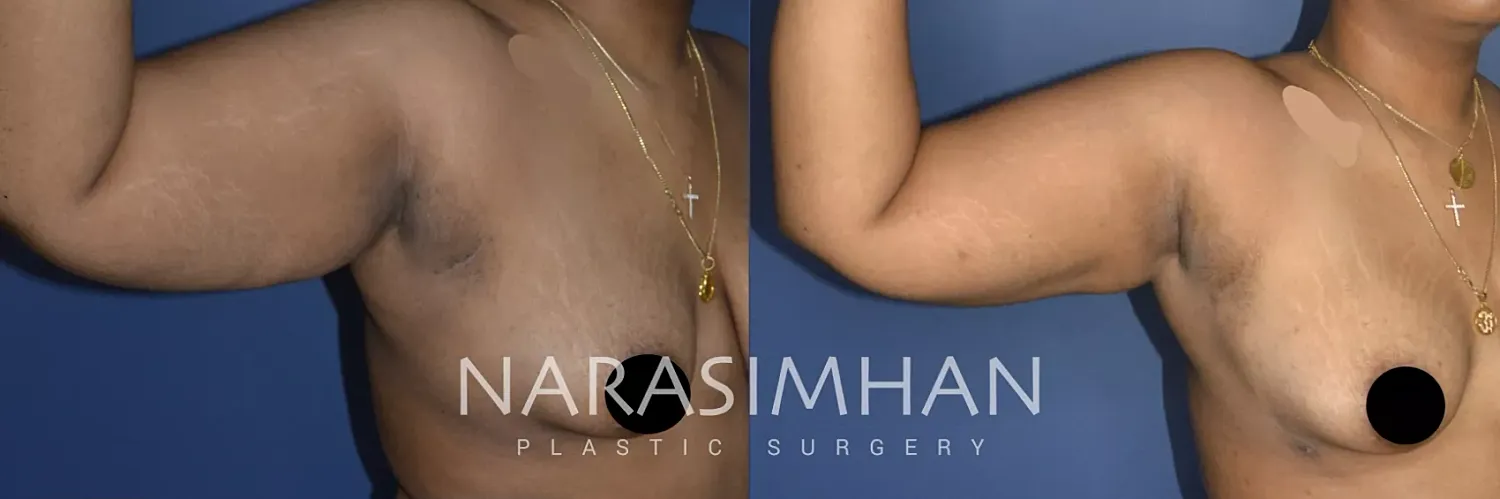 Liposuction Before & After