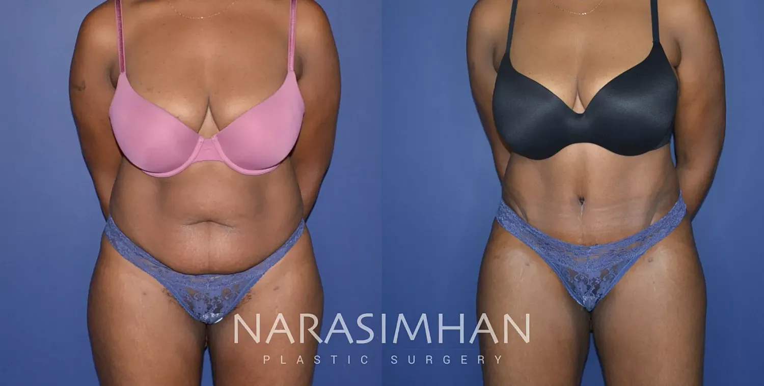 Liposuction Before & After