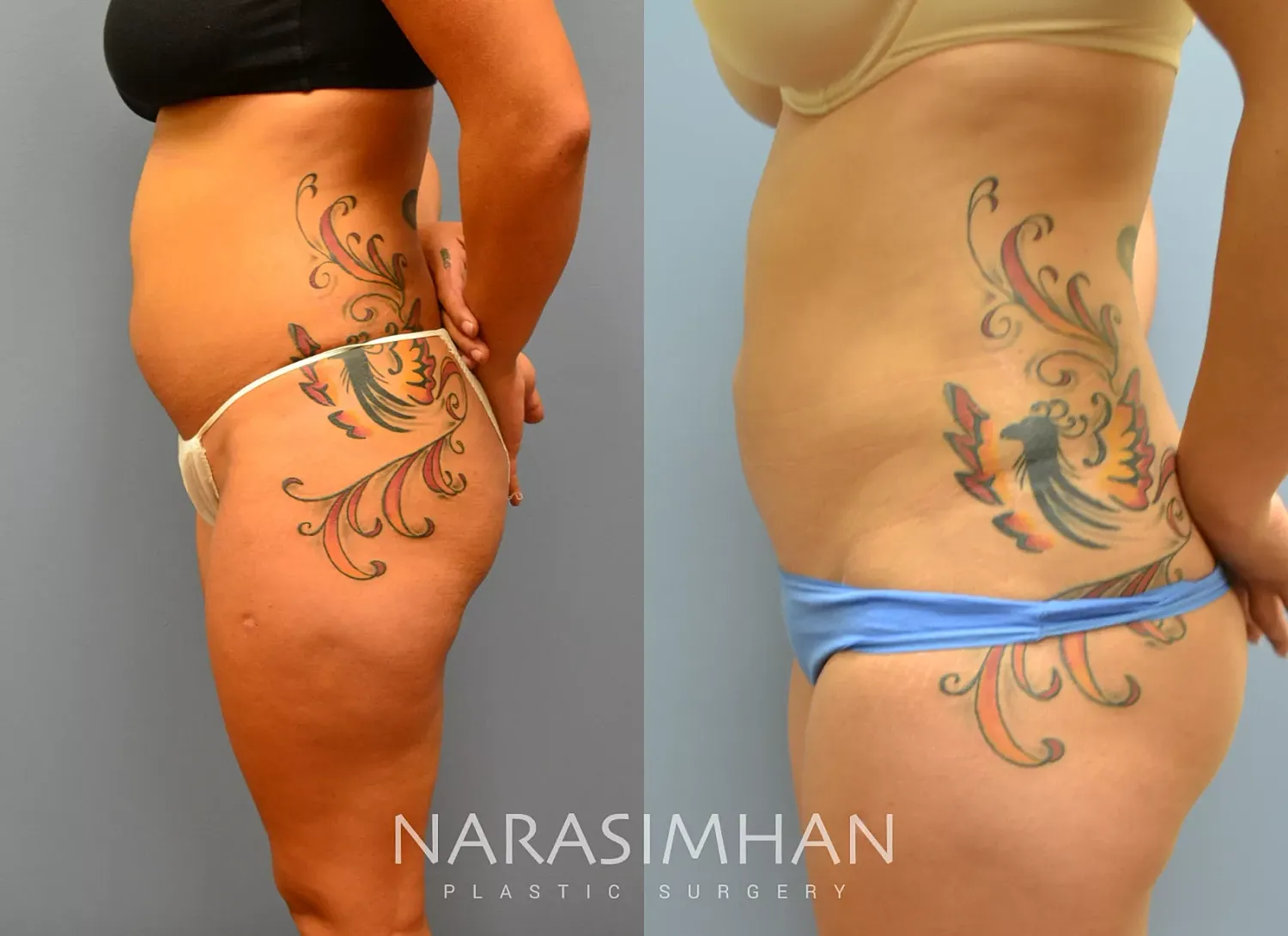 Liposuction Before & After