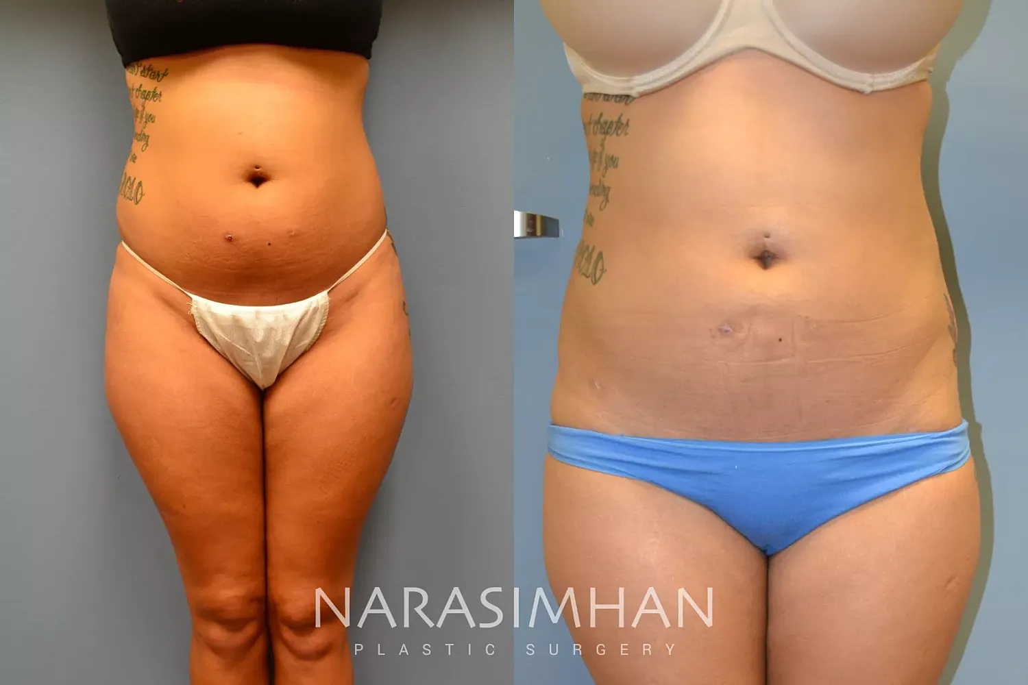 Liposuction Before & After