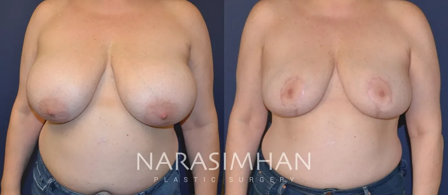 Liposuction Before & After