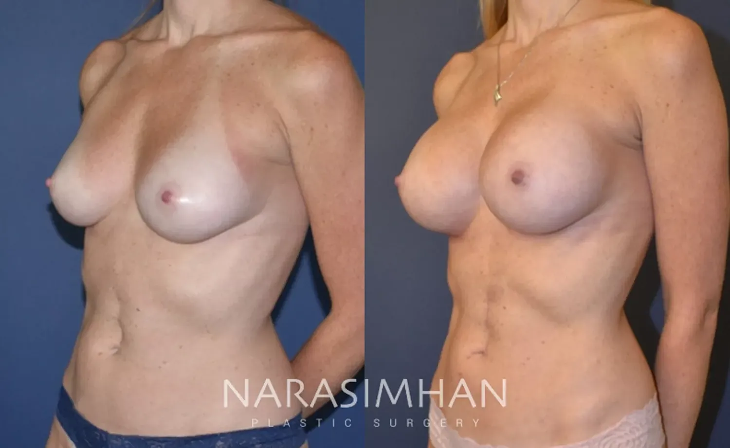 Liposuction Before & After