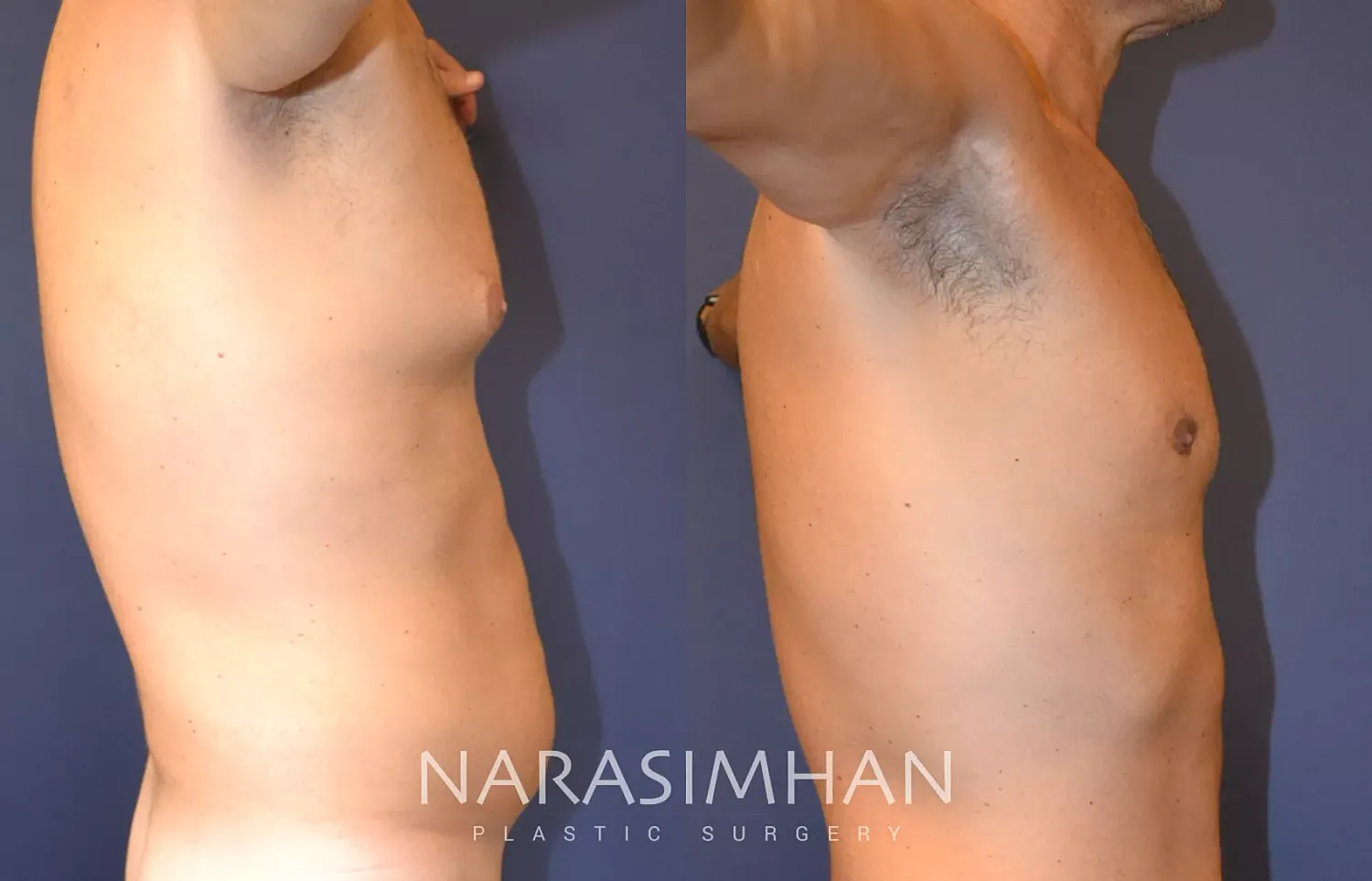 Liposuction Before & After