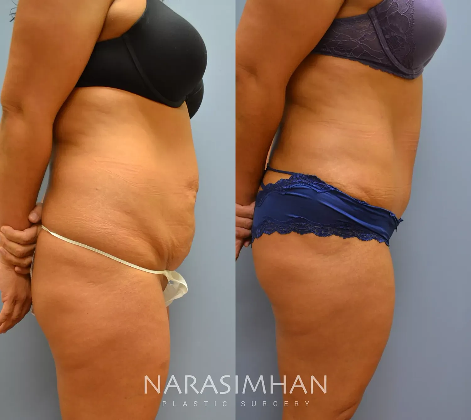 Liposuction Before & After