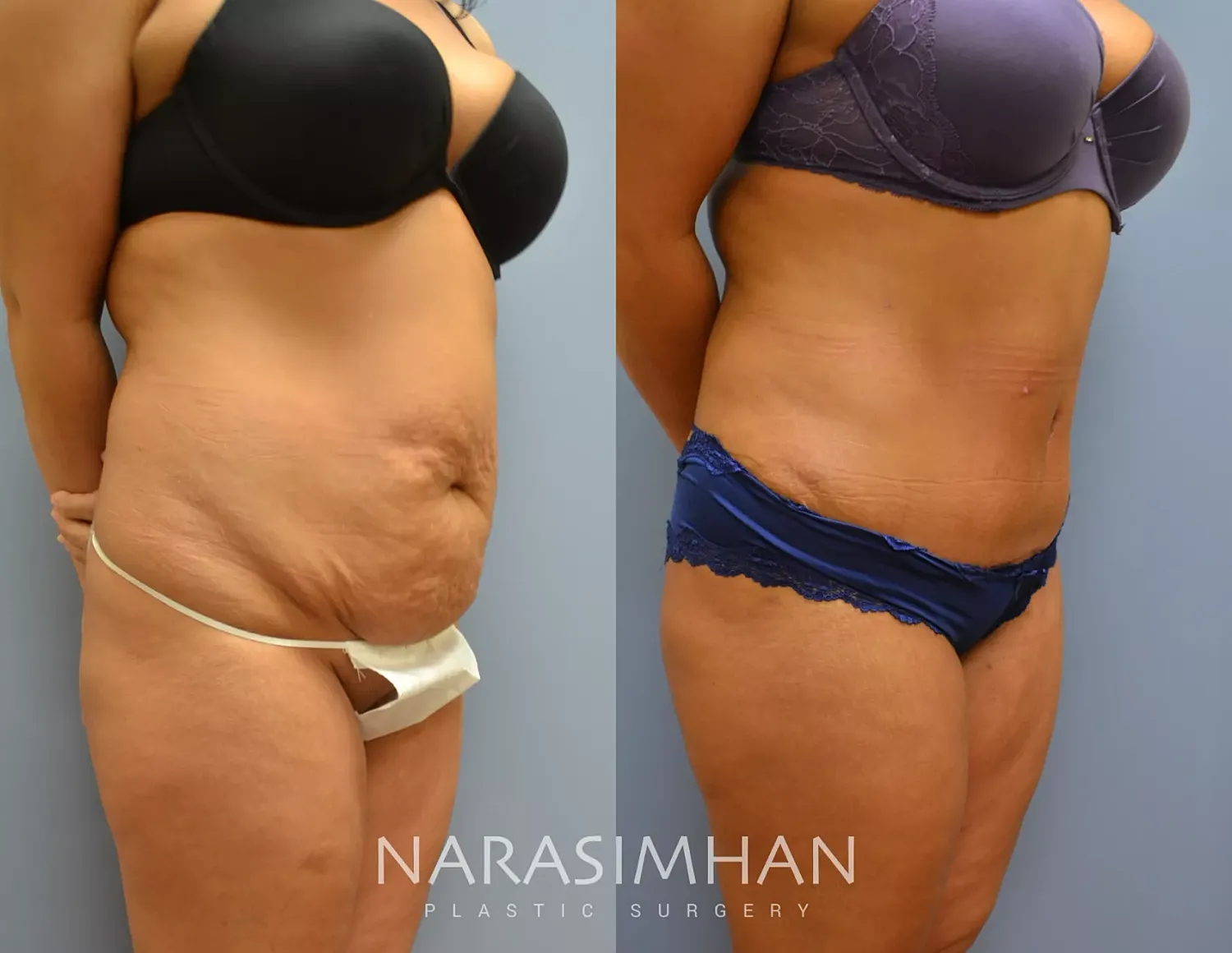 Liposuction Before & After