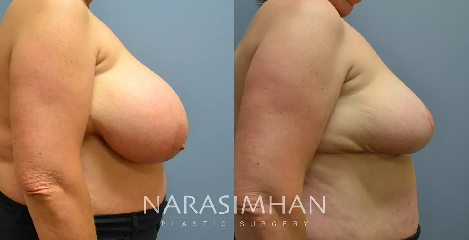 Breast Reduction Before & After