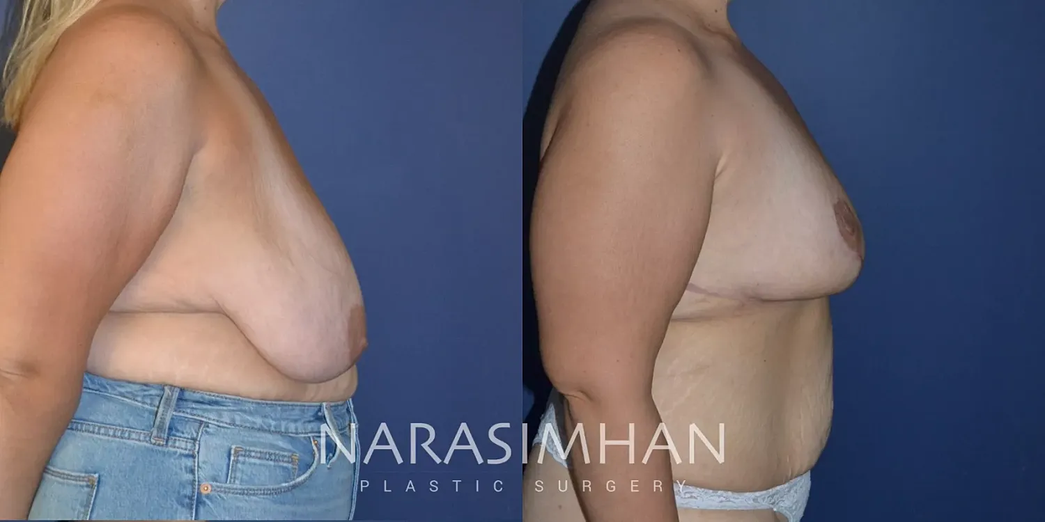 Breast Reduction Before & After