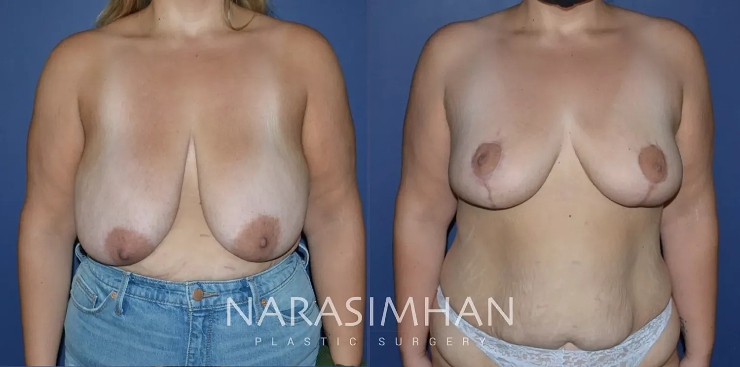Breast Reduction Before & After