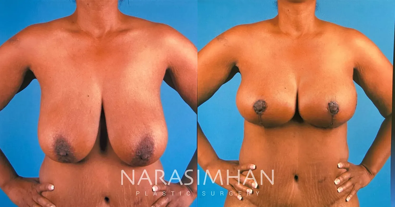 Breast Reduction Before & After