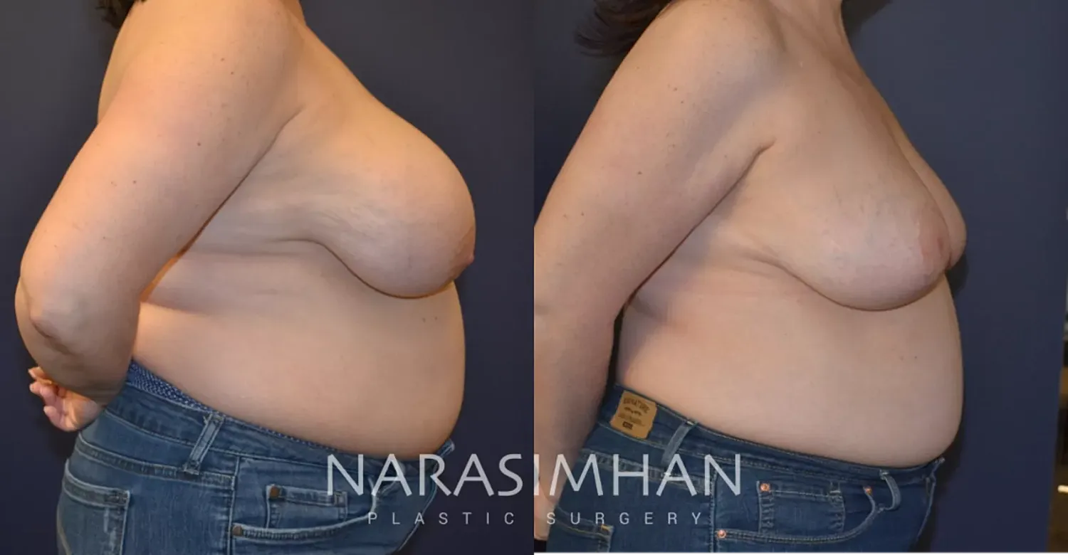 Breast Reduction Before & After