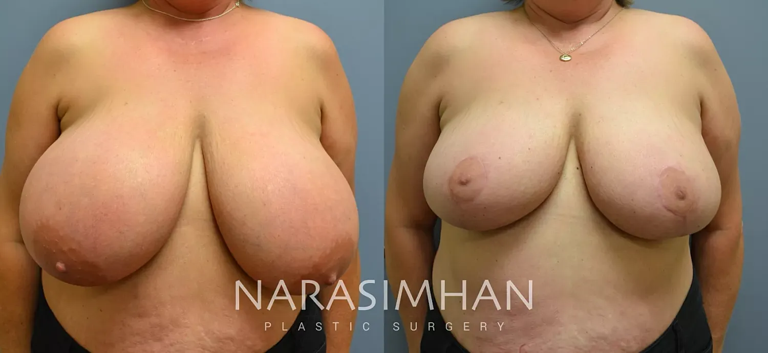 Breast Reduction Before & After