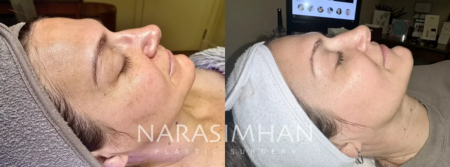 Sciton Laser Before & After