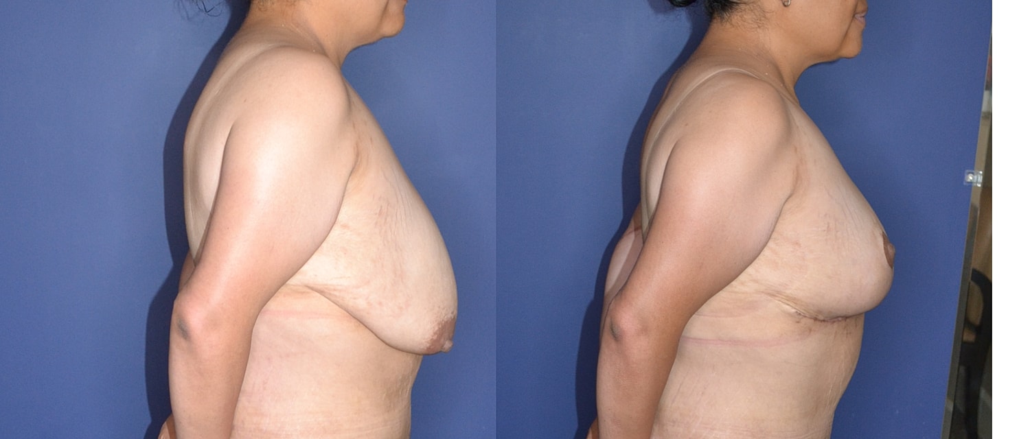Mastopexy Before & After