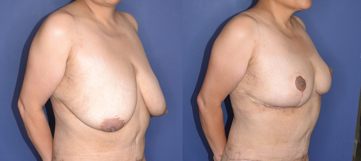 Mastopexy Before & After